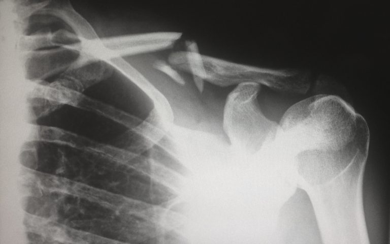 x-ray of a broken shoulder indicating inflammation